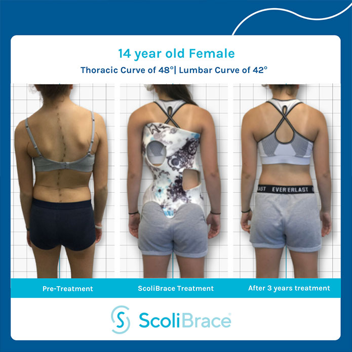 Scoliosis Bracing Huntington Chiropractors