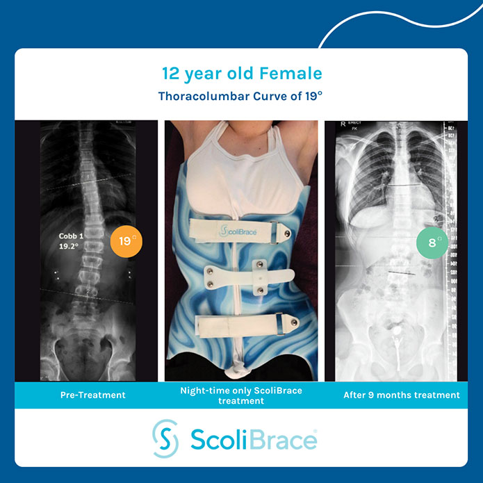 Before and after KyphoBrace