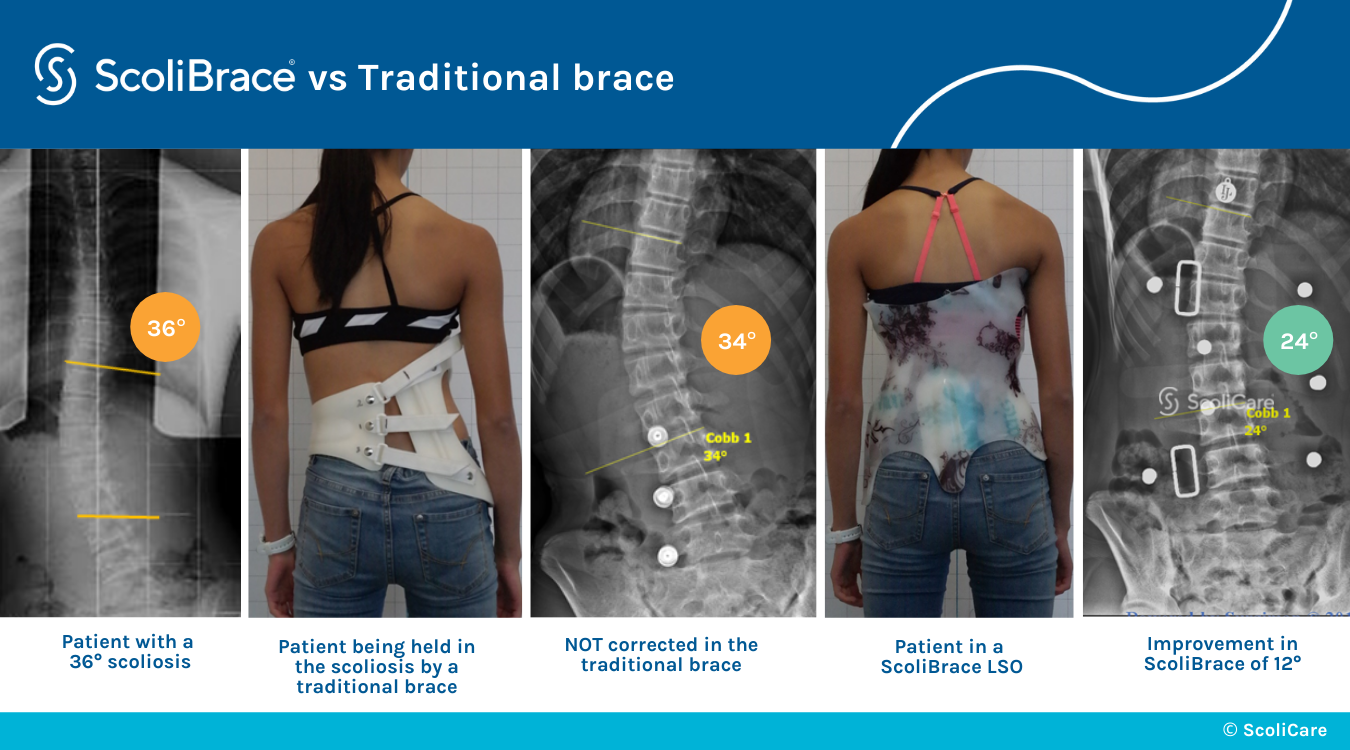 ScoliBrace before and after