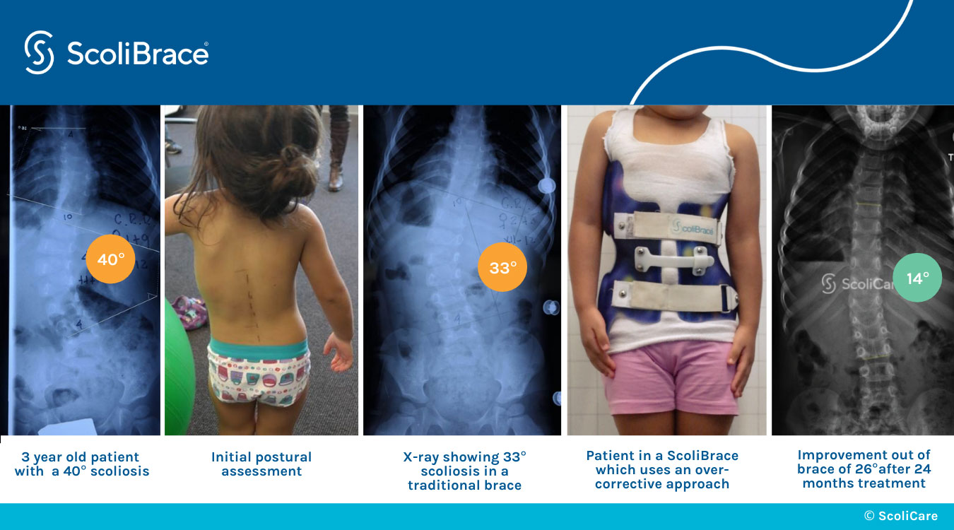 ScoliBrace before and after