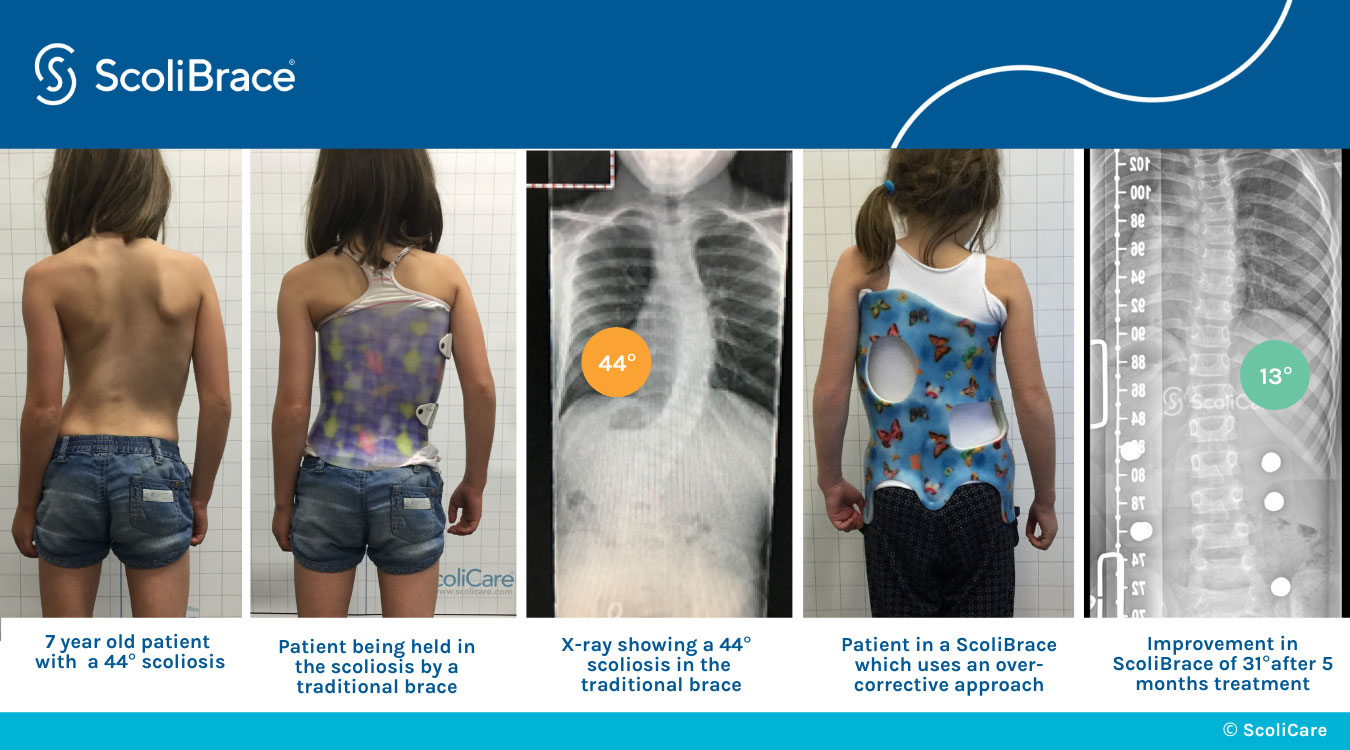 ScoliBrace before and after