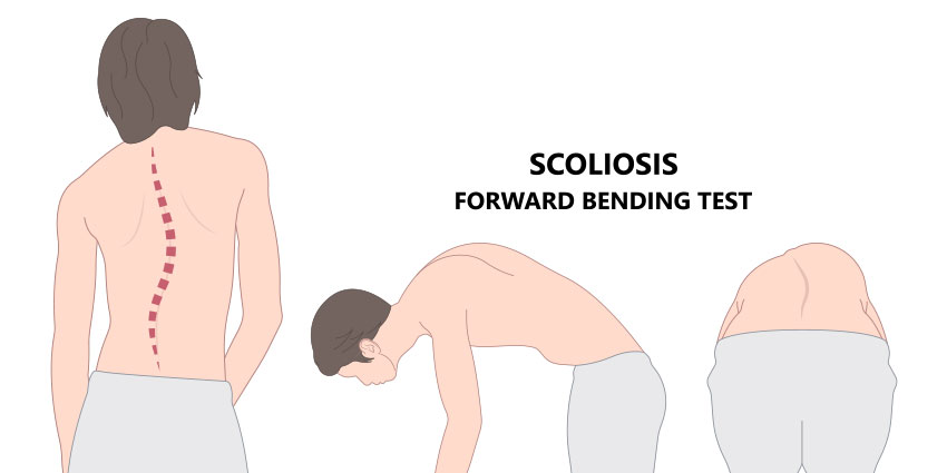 Adam's Forward Bend Test for Scoliosis at Waterfront Chiropractic in New York