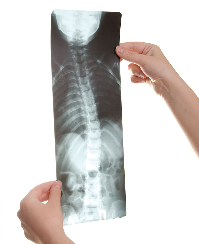 Patient xray of scoliosis at Waterfront Chiropractic in New York